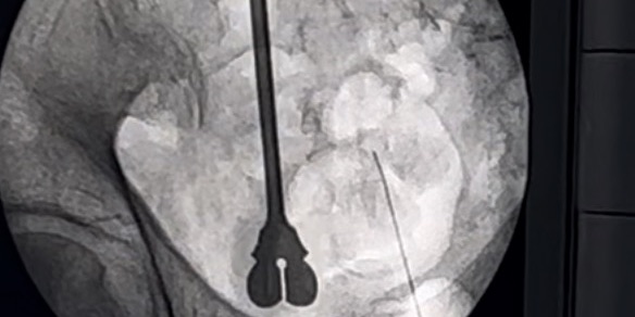 Dolor de Cadera — Clínica San Giovanni, Asunción