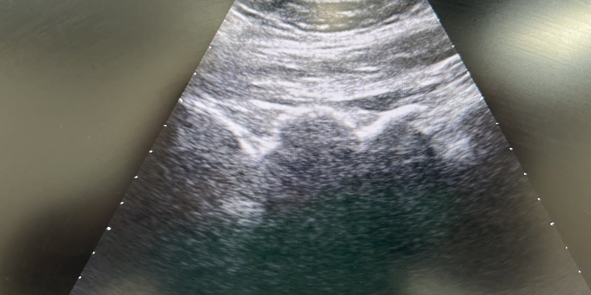 Inyecciones Epidurales con Corticoides — Clínica San Giovanni, Asunción
