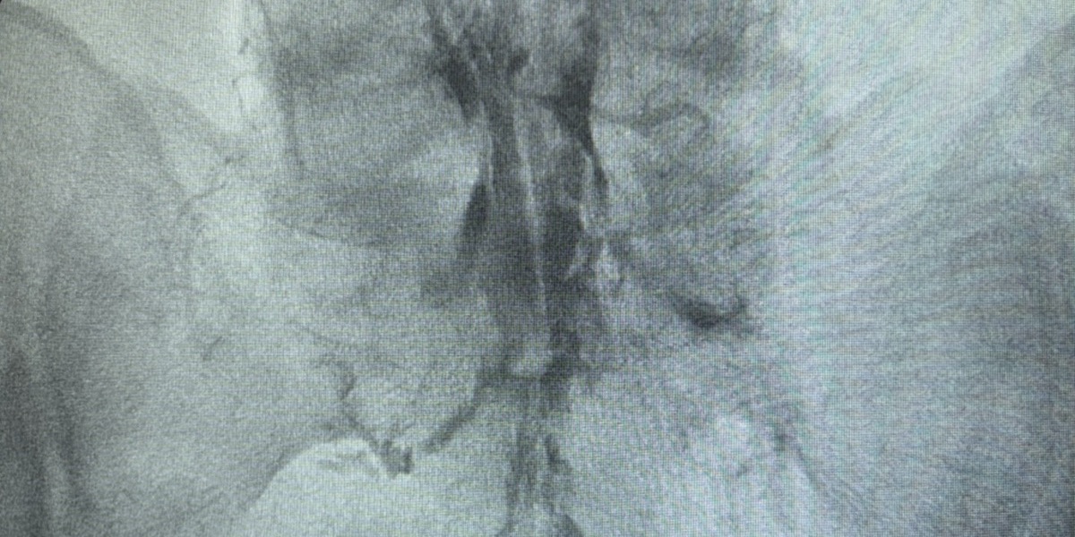 Epiduroplastia — Clínica San Giovanni, Asunción