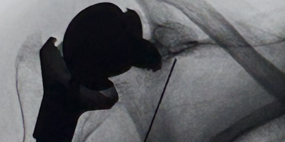 Dolor de Hombro — Clínica San Giovanni, Asunción