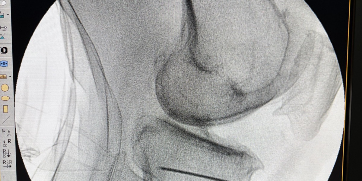 Artrosis de Rodilla — Clínica San Giovanni, Asunción