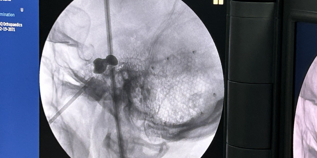 Neuralgia del Trigémino — Clínica San Giovanni, Asunción